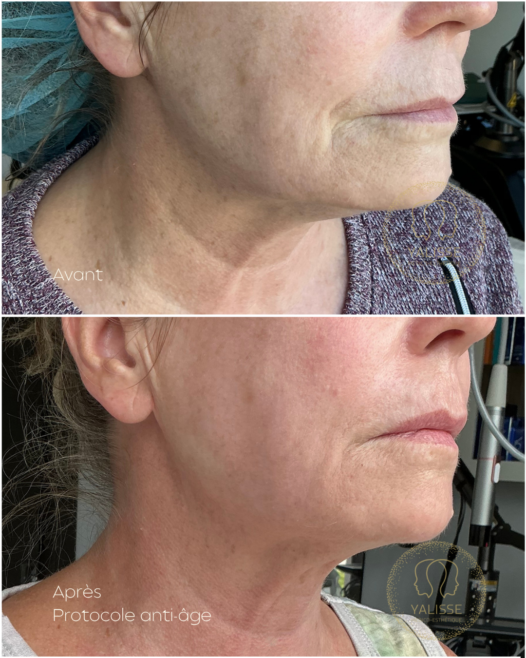 Genius RF Microneedling – Skin Rejuvenation (eyes)