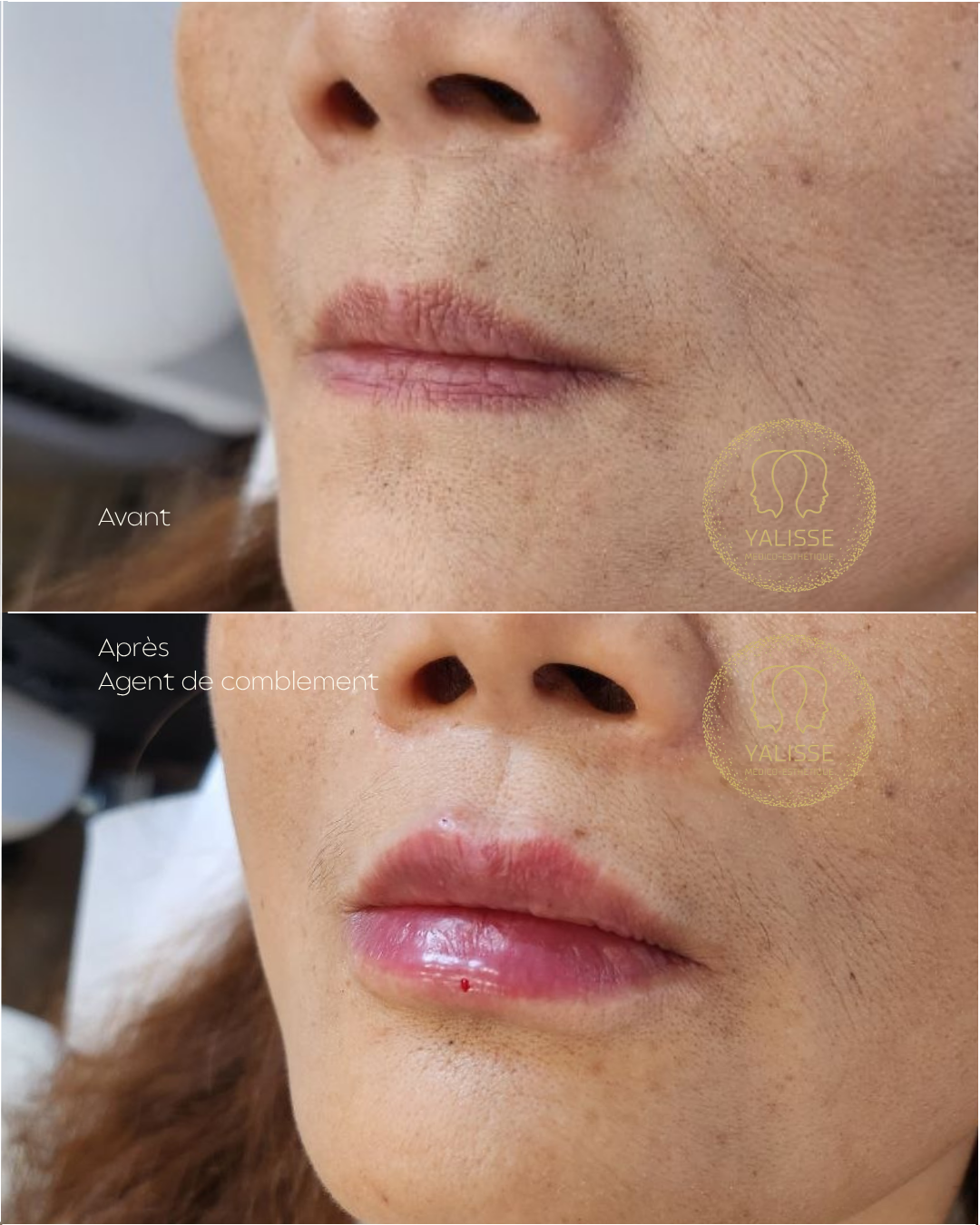 Hyaluronic acid dermal fillers