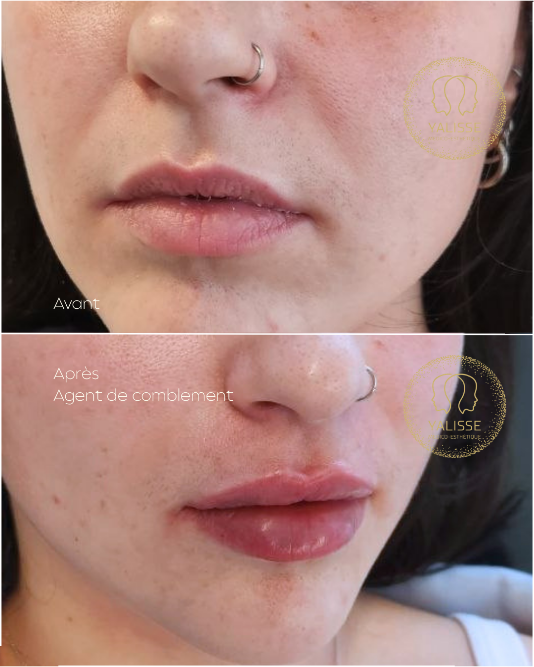 Hyaluronic acid dermal fillers