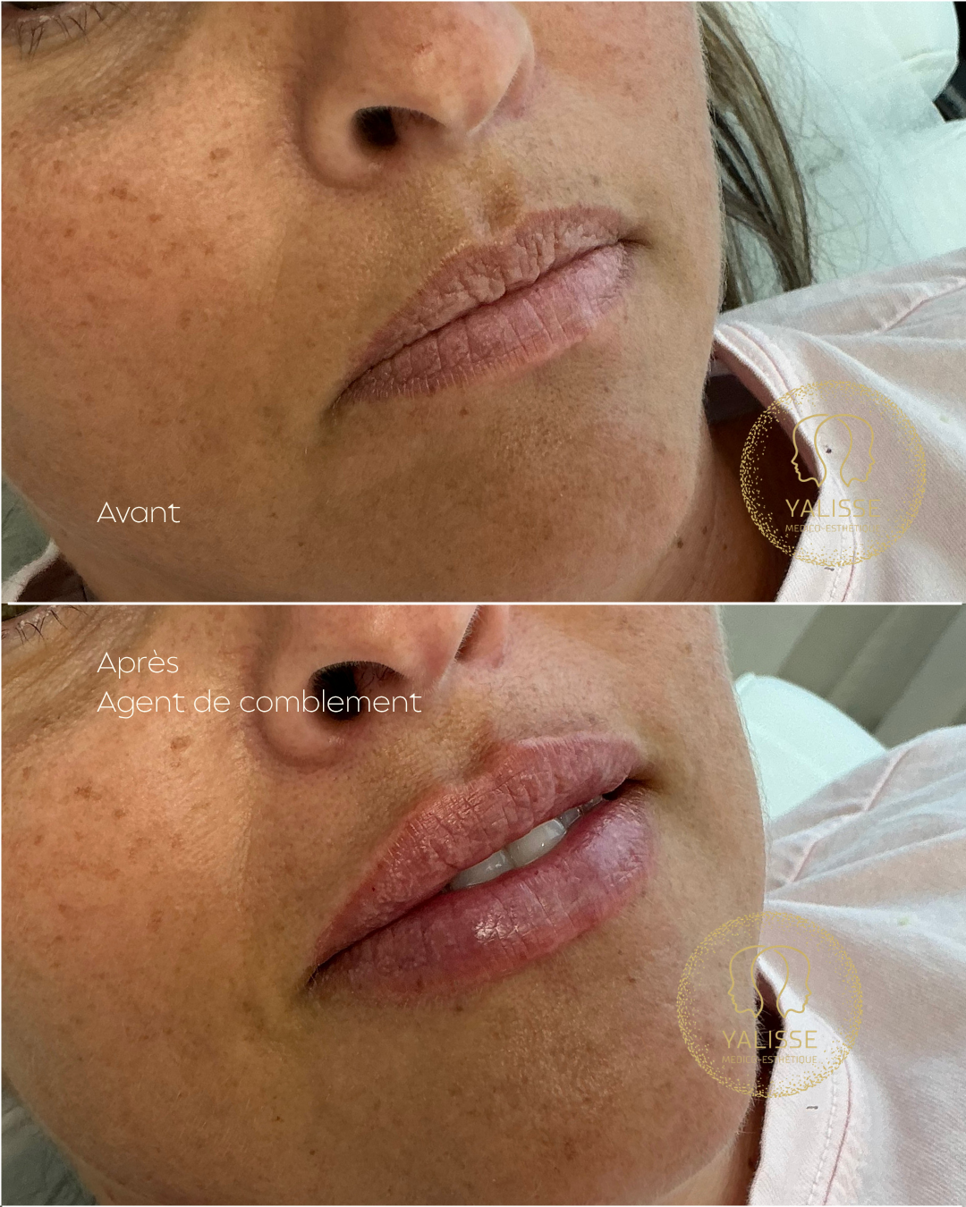 Hyaluronic acid dermal fillers