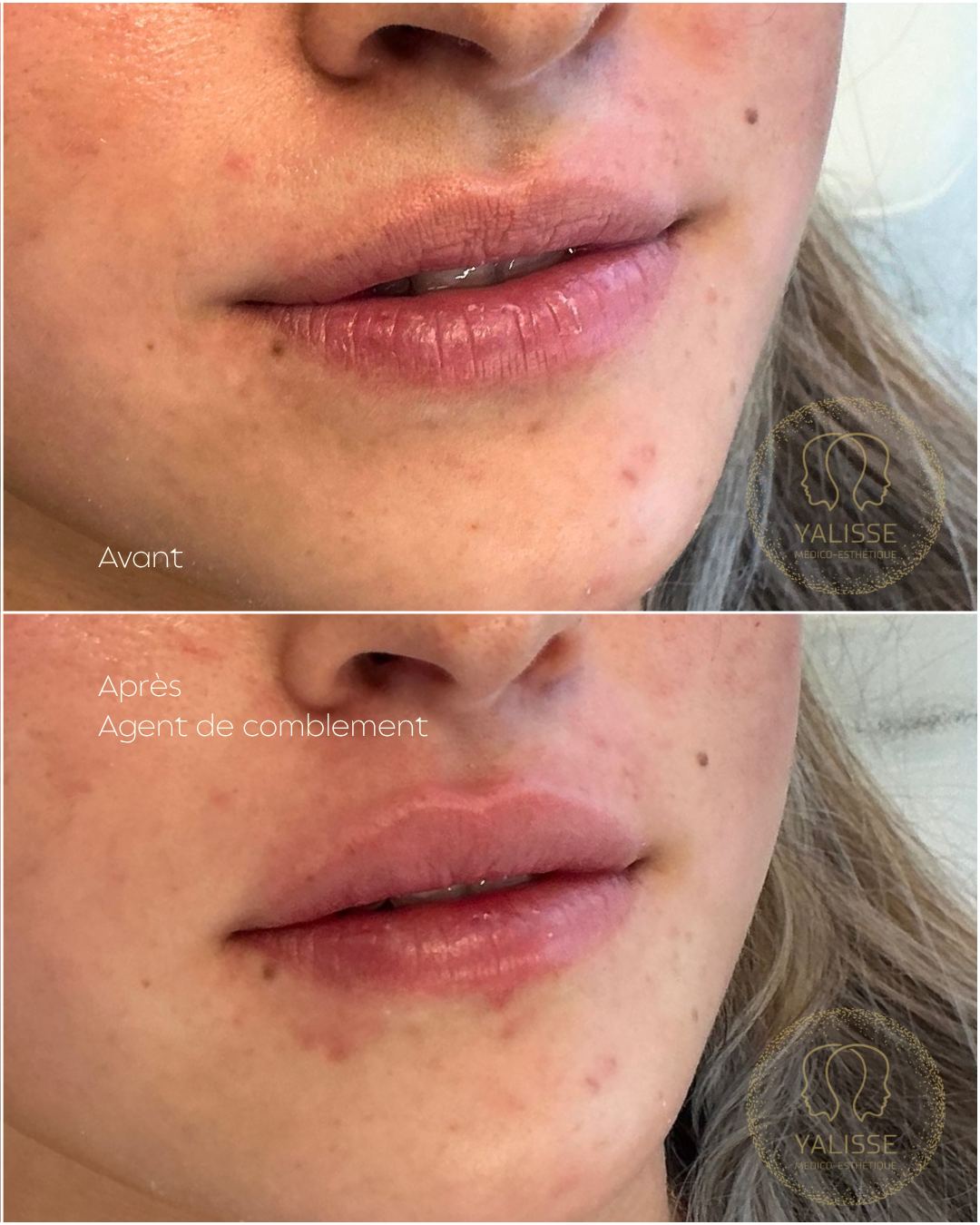 Hyaluronic acid dermal fillers