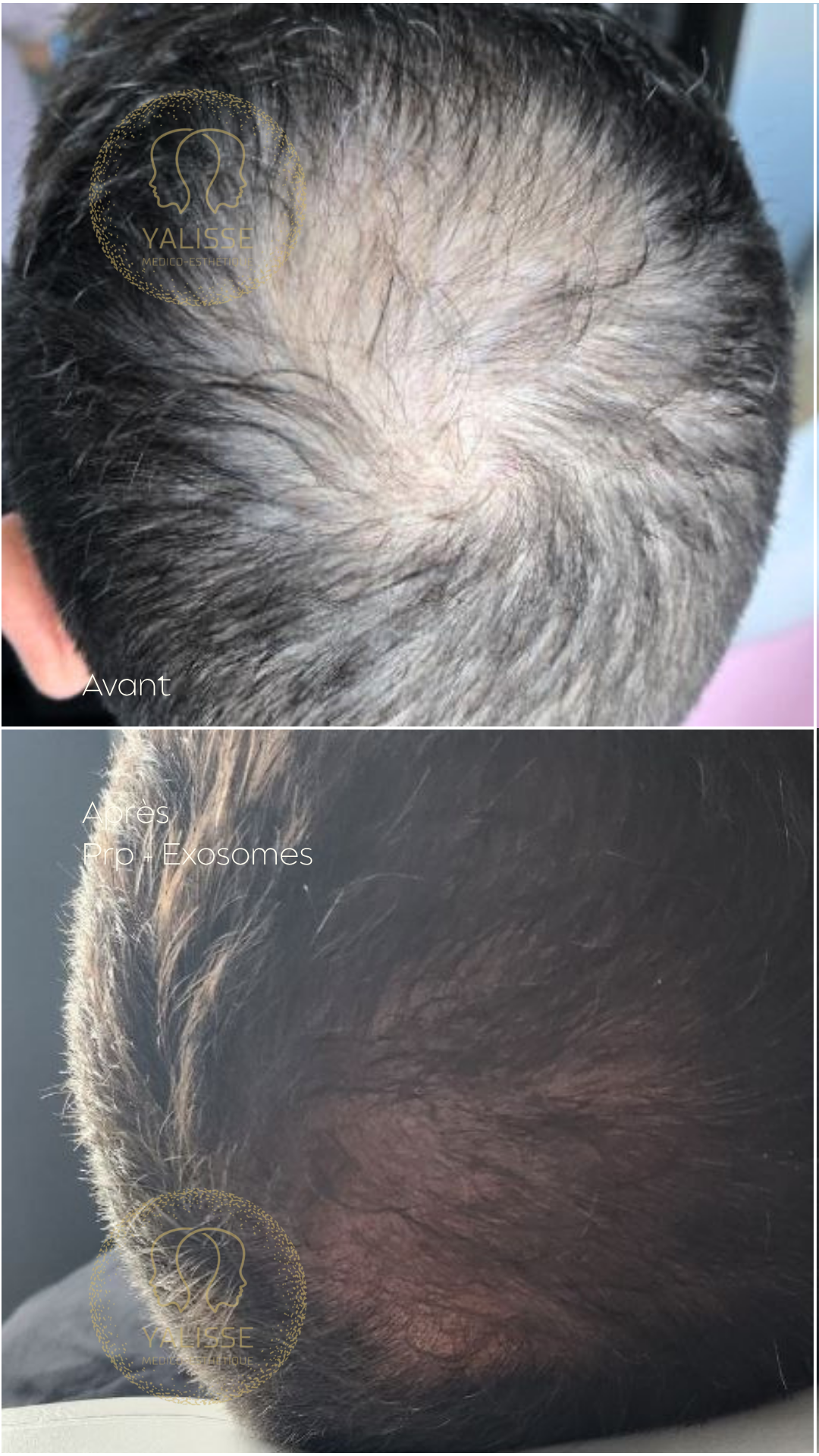Plasma riche en plaquettes (PRP)