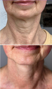 Microneedling et Radiofréquence Genius – Rajeunissement de la Peau
