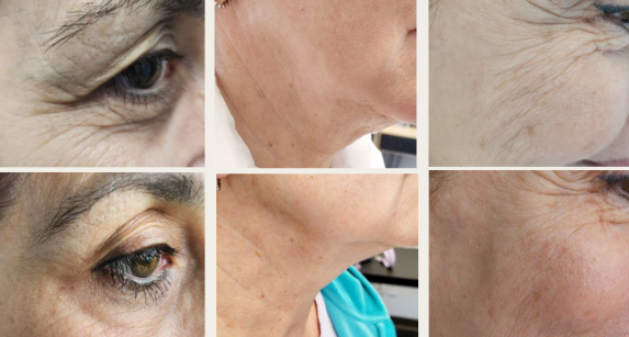 Microneedling et Radiofréquence Genius – Rajeunissement de la Peau