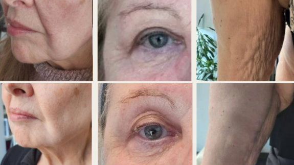 Microneedling et Radiofréquence Genius – Rajeunissement de la Peau
