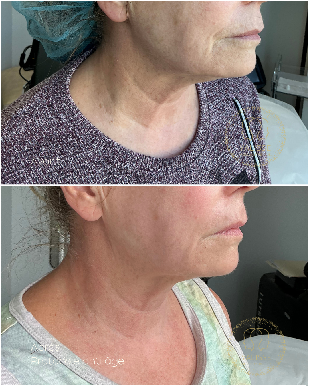 Genius RF Microneedling – Skin Rejuvenation