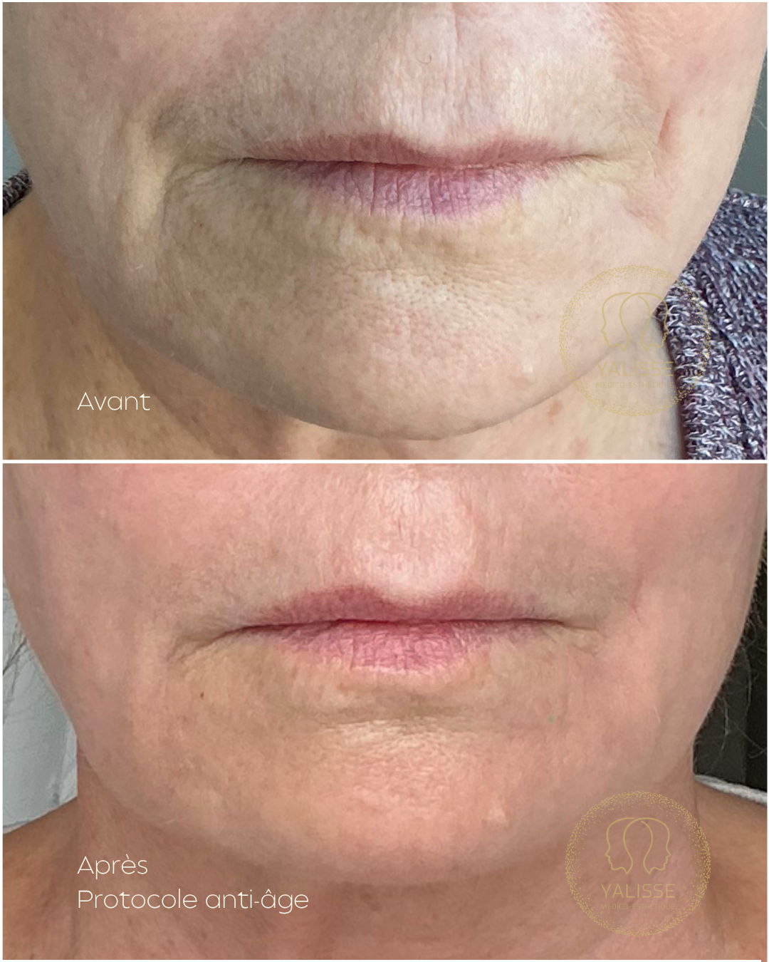 Genius RF Microneedling – Skin Rejuvenation