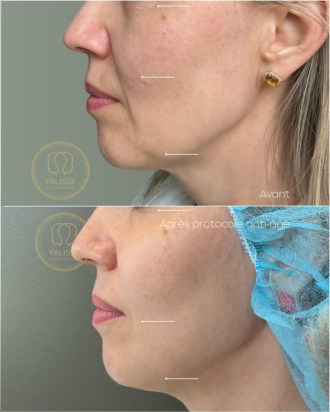 Genius RF Microneedling – Skin Rejuvenation