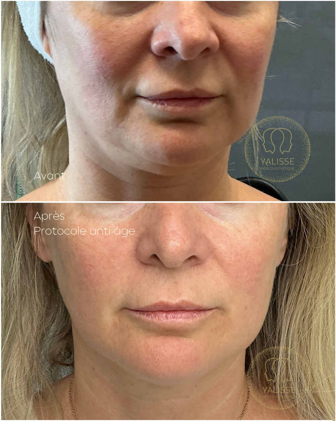 Microneedling et Radiofréquence Genius – Rajeunissement de la Peau