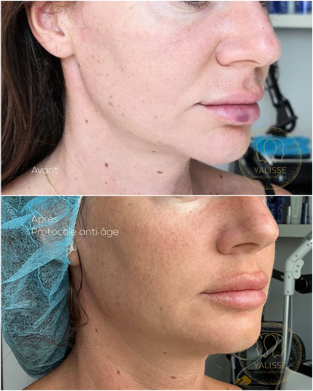 Microneedling et Radiofréquence Genius – Rajeunissement de la Peau