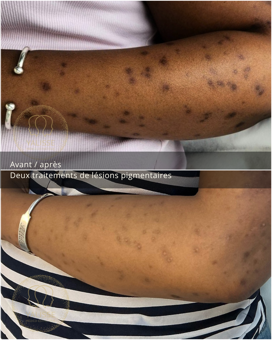 Pigmented lesion treatment