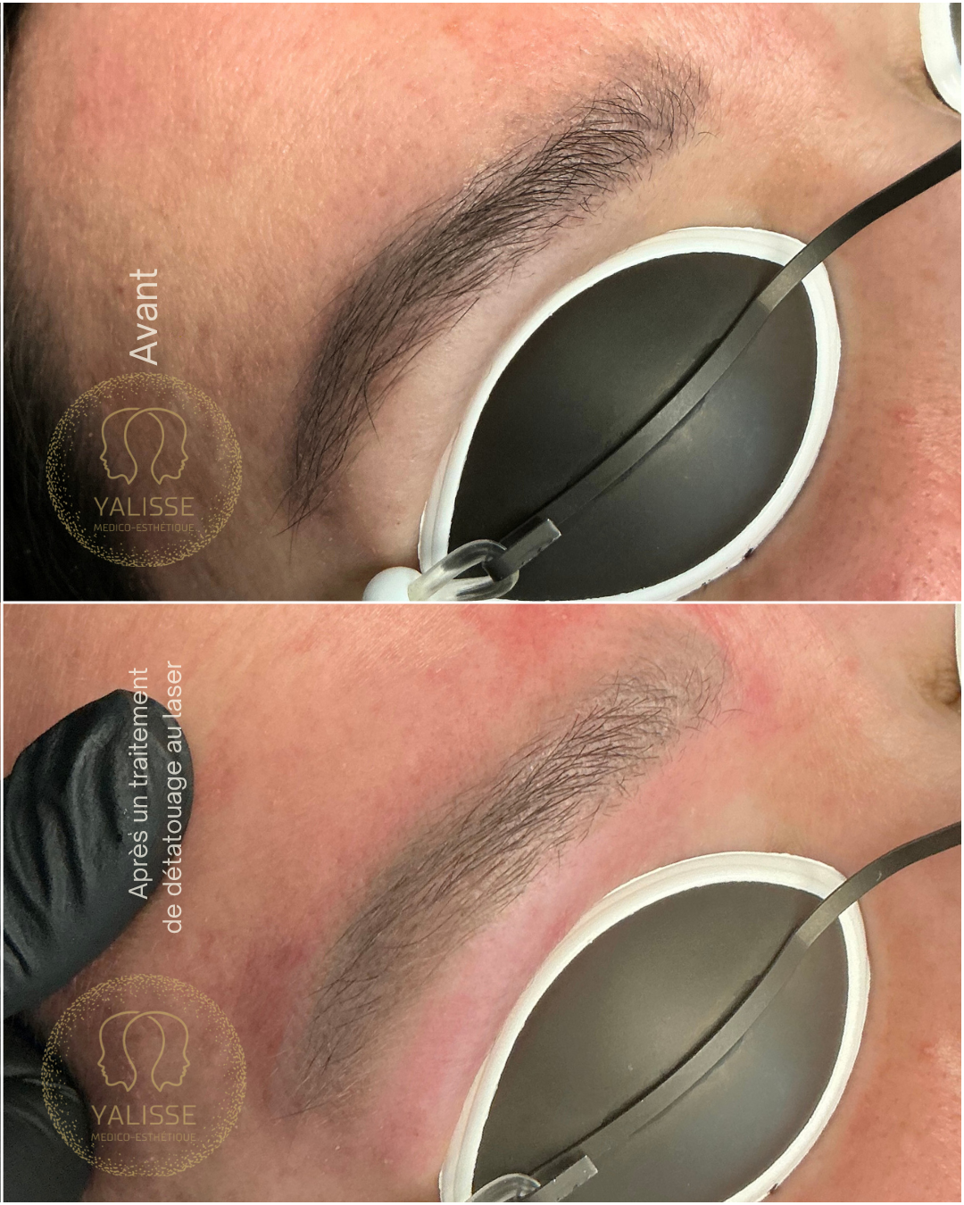 Laser Tattoo Removal Treatment (eyebrows)