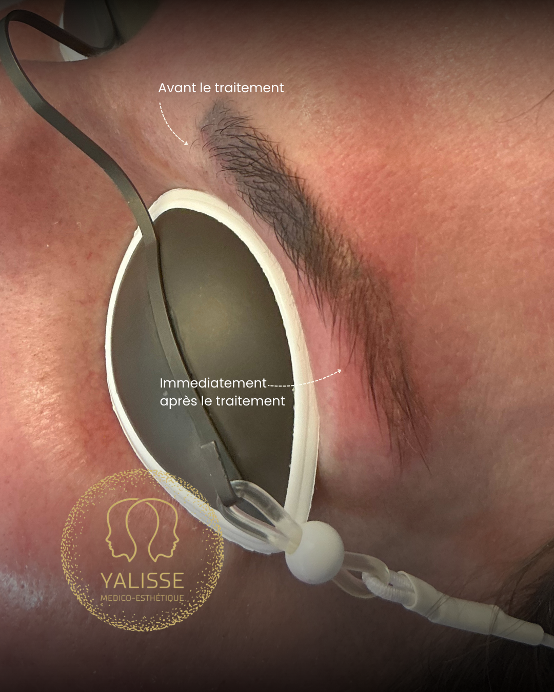 Laser Tattoo Removal Treatment (eyebrows)