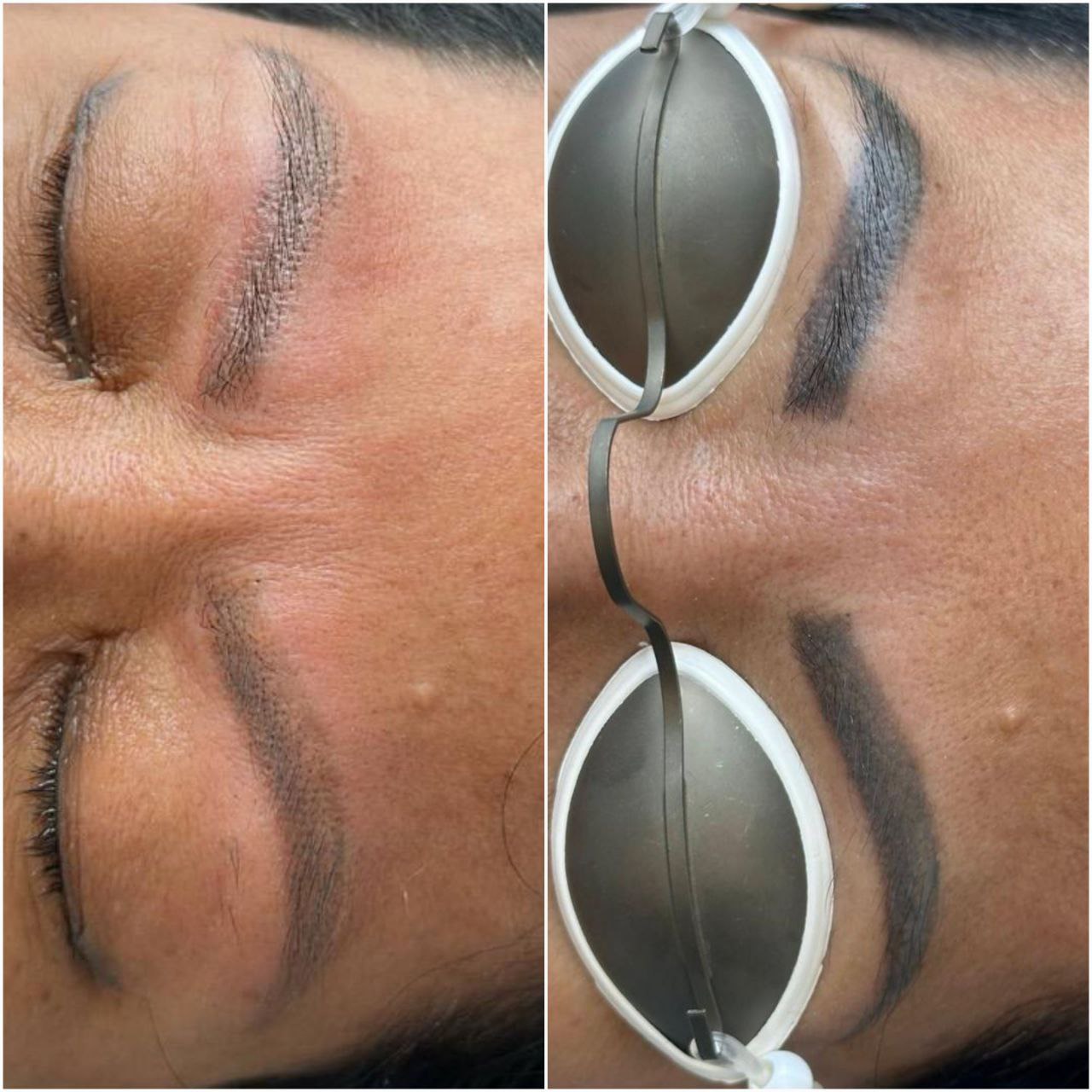 Laser Tattoo Removal Treatment (eyebrows)